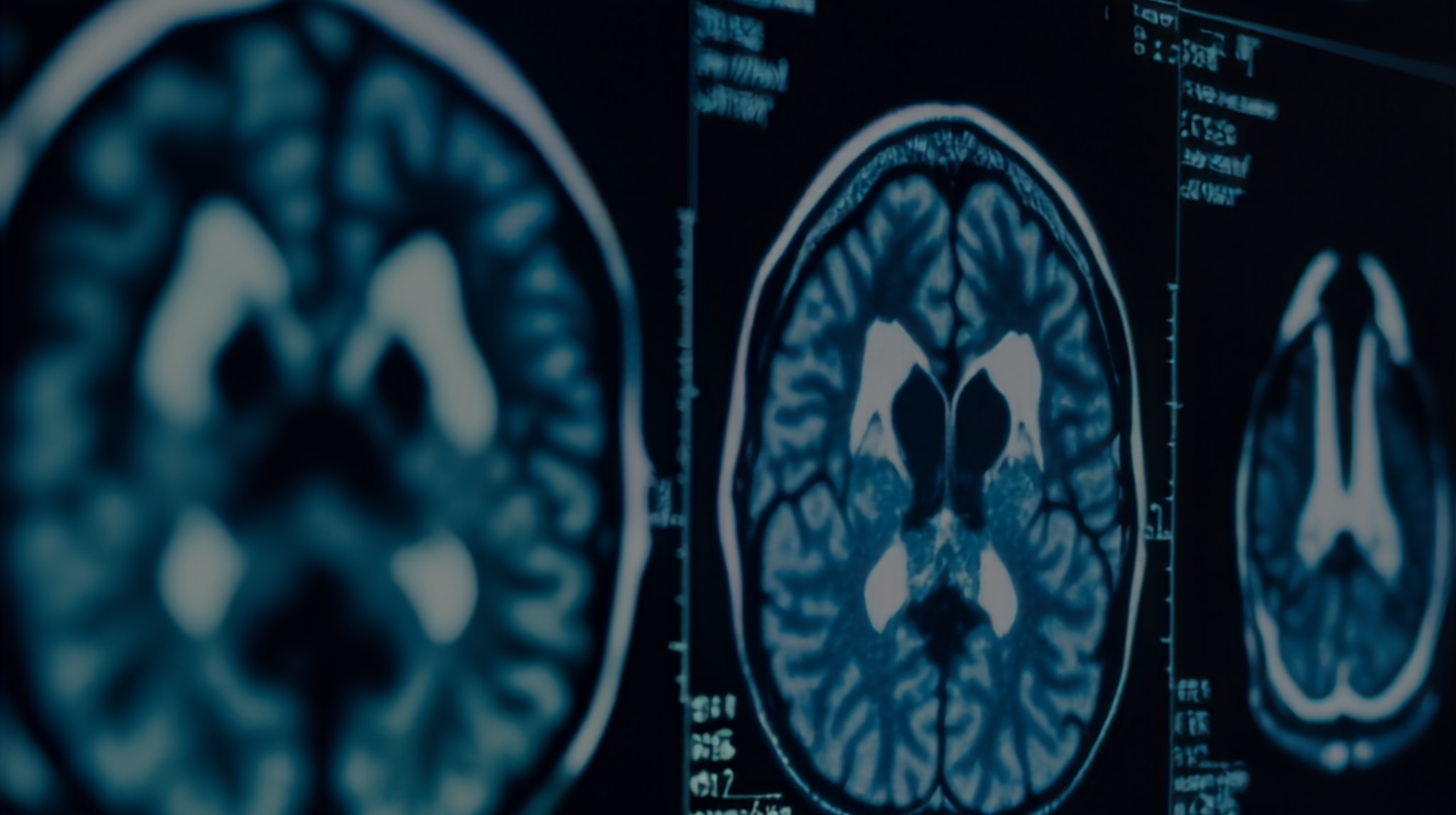 MRI brain scan images in blue tint, showing axial slices of the cerebrum and ventricles